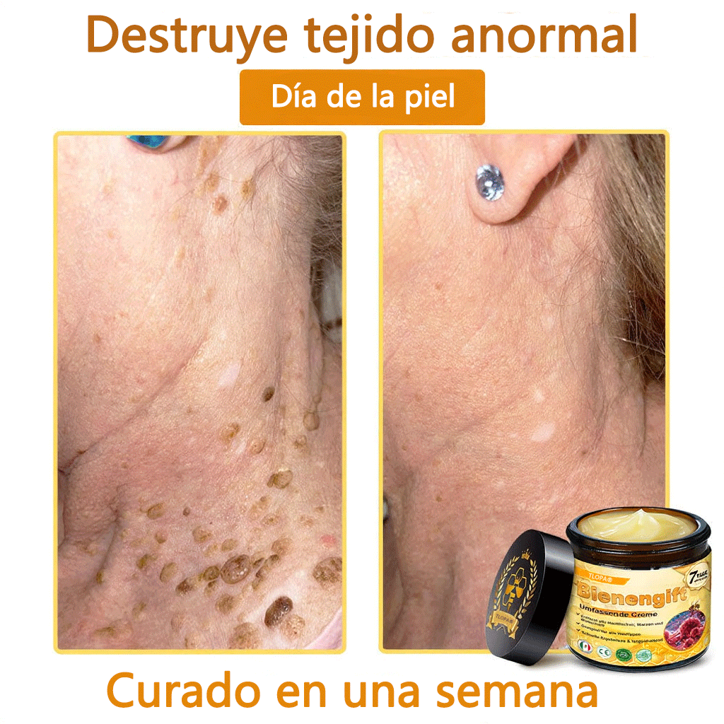 🎁 Crema TLOPA® con complejo de veneno de abeja: antienvejecimiento, hidratante, reparadora de la piel, mejora la textura de la piel, trata el acné y la pigmentación, elimina verrugas y lunares y alivia la psoriasis.