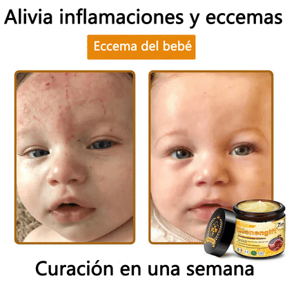 🎁 Crema TLOPA® con complejo de veneno de abeja: antienvejecimiento, hidratante, reparadora de la piel, mejora la textura de la piel, trata el acné y la pigmentación, elimina verrugas y lunares y alivia la psoriasis.