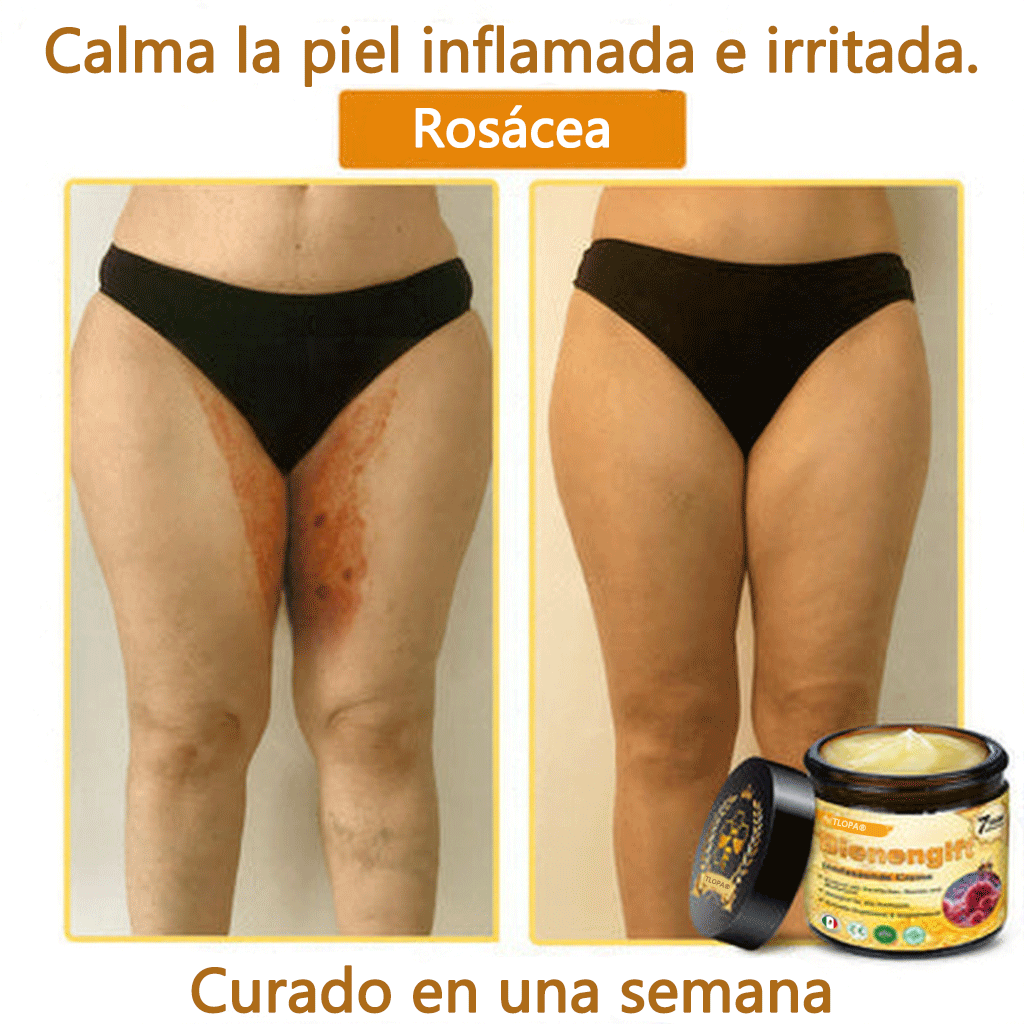 🎁 Crema TLOPA® con complejo de veneno de abeja: antienvejecimiento, hidratante, reparadora de la piel, mejora la textura de la piel, trata el acné y la pigmentación, elimina verrugas y lunares y alivia la psoriasis.