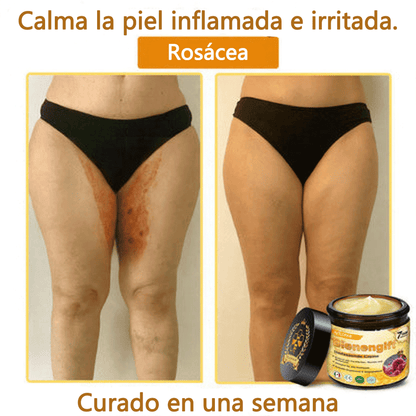 🎁 Crema TLOPA® con complejo de veneno de abeja: antienvejecimiento, hidratante, reparadora de la piel, mejora la textura de la piel, trata el acné y la pigmentación, elimina verrugas y lunares y alivia la psoriasis.