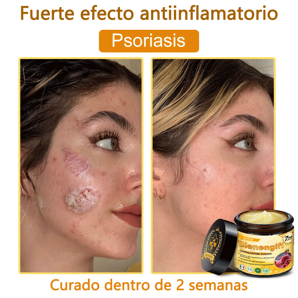 🎁 Crema TLOPA® con complejo de veneno de abeja: antienvejecimiento, hidratante, reparadora de la piel, mejora la textura de la piel, trata el acné y la pigmentación, elimina verrugas y lunares y alivia la psoriasis.