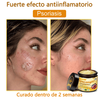 🎁 Crema TLOPA® con complejo de veneno de abeja: antienvejecimiento, hidratante, reparadora de la piel, mejora la textura de la piel, trata el acné y la pigmentación, elimina verrugas y lunares y alivia la psoriasis.
