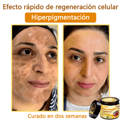 🎁 Crema TLOPA® con complejo de veneno de abeja: antienvejecimiento, hidratante, reparadora de la piel, mejora la textura de la piel, trata el acné y la pigmentación, elimina verrugas y lunares y alivia la psoriasis.