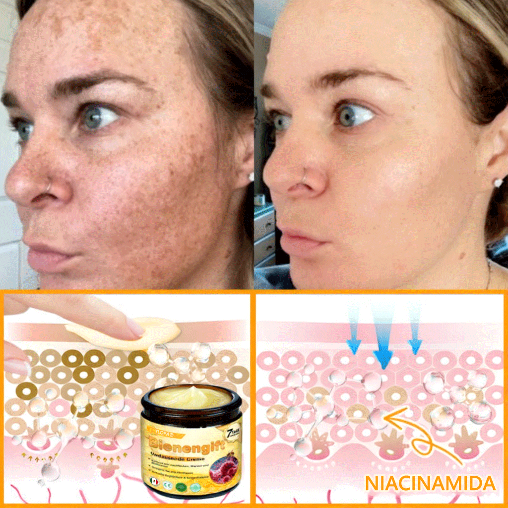 🎁 Crema TLOPA® con complejo de veneno de abeja: antienvejecimiento, hidratante, reparadora de la piel, mejora la textura de la piel, trata el acné y la pigmentación, elimina verrugas y lunares y alivia la psoriasis.