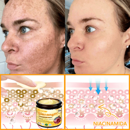 🎁 Crema TLOPA® con complejo de veneno de abeja: antienvejecimiento, hidratante, reparadora de la piel, mejora la textura de la piel, trata el acné y la pigmentación, elimina verrugas y lunares y alivia la psoriasis.